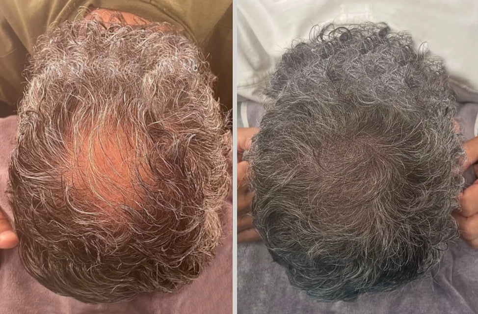 Hair Transplants VS Scalp Micropigmentation (SMP)