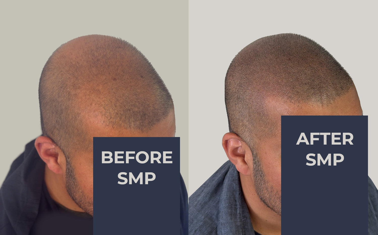 SMP for hair loss. How we disguise thinning patches with a scalp tattoo
